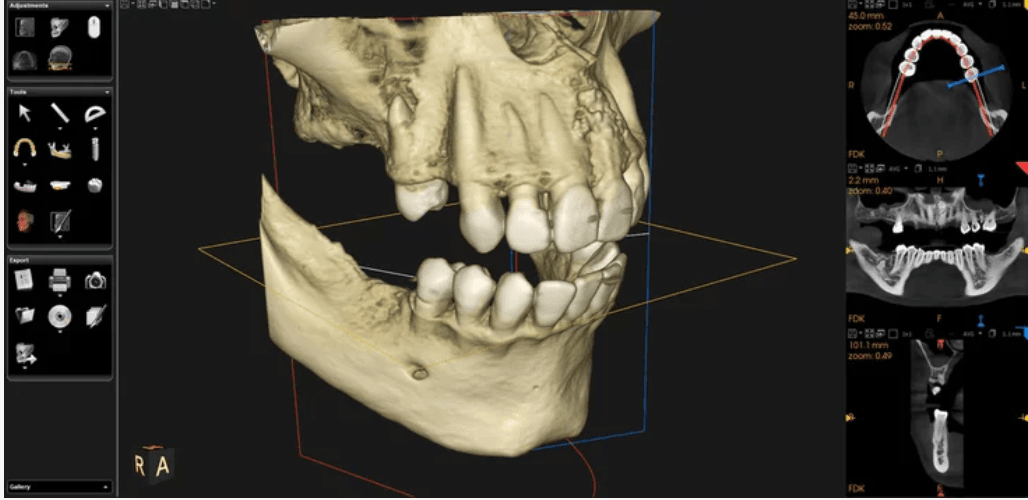 A detailed 3D digital scan of a human skull showing teeth alignment and jaw structure, with additional cross-sectional views displayed on the side – Smile Haven